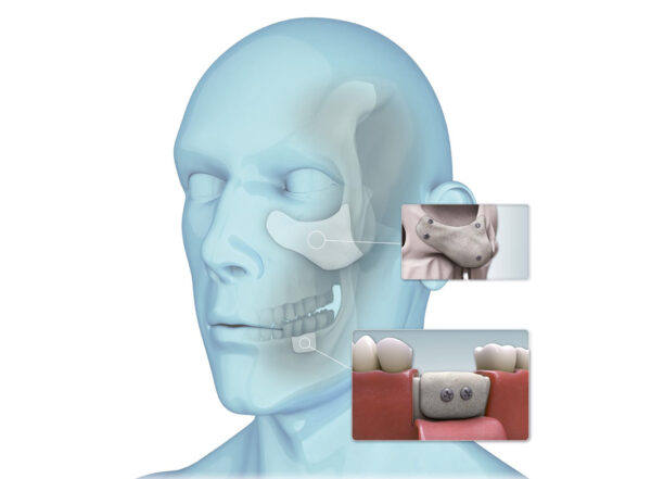 SMP013010 Smartbone Plate - Image 3